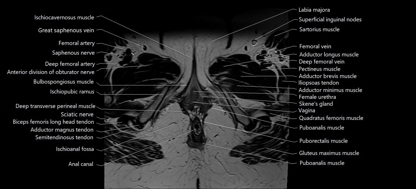 Axial cross sectional anatomy of female pelvis (MRI 3T) image 43.webp
